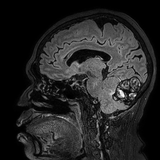 Cavernous hemangioma of the cerebellar falx (Radiopaedia 73025-83724 Sagittal FLAIR 123).jpg