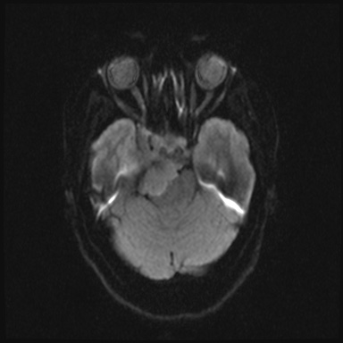 Cavernous sinus meningioma (Radiopaedia 63682-72367 DWI 28).jpg