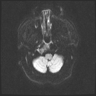 File:Cavernous sinus meningioma (Radiopaedia 63682-72367 DWI 44).jpg