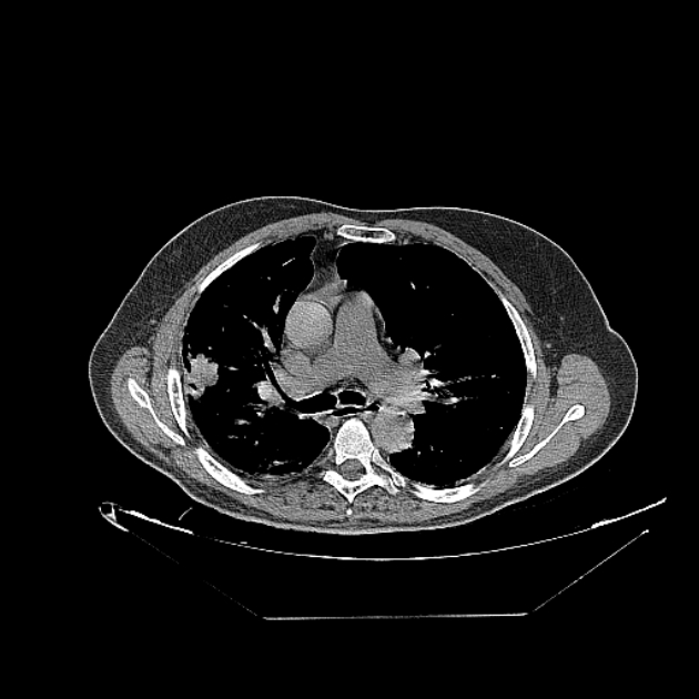 Cavitating bronchogenic carcinoma (Radiopaedia 44489-48162 Axial non-contrast 34).jpg