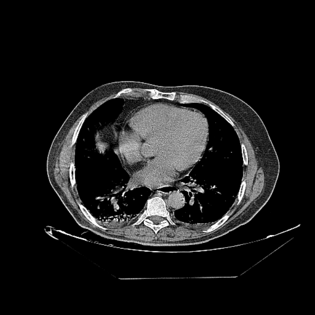 Cavitating bronchogenic carcinoma (Radiopaedia 44489-48162 Axial non-contrast 55).jpg