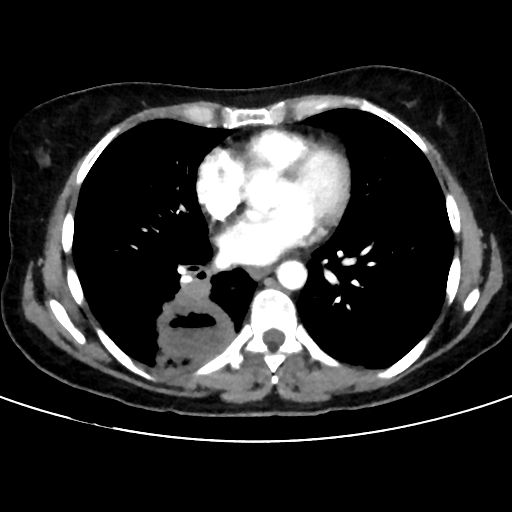 File:Cavitating lung mass - squamous cell carcinoma (Radiopaedia 48047-52854 B 29).png