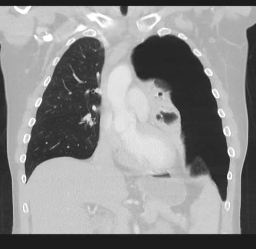 Cavitating pneumonia complicated by pneumothorax (Radiopaedia 48149-52994 Coronal lung window 25).png