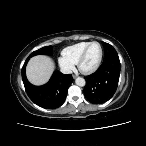 Cecal adenocarcinoma (Radiopaedia 75909-87331 A 13).jpg