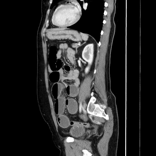 Cecal adenocarcinoma (Radiopaedia 75909-87331 C 47).jpg