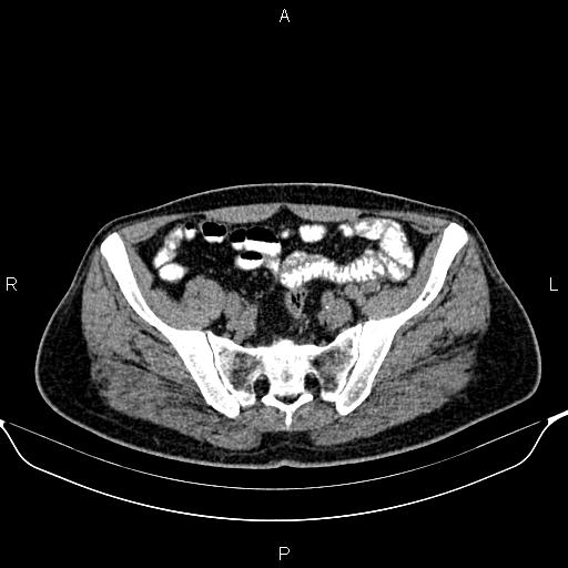 File:Cecal adenocarcinoma (Radiopaedia 85324-100916 Axial non-contrast 76).jpg