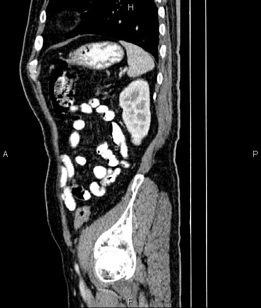 Cecal cancer with appendiceal mucocele (Radiopaedia 91080-108651 E 77).jpg