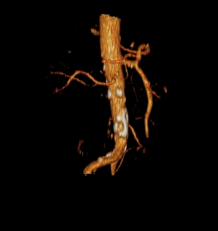 File:Celiacomesenteric trunk (Radiopaedia 67660-77071 VR C+ arterial phase 2).jpg