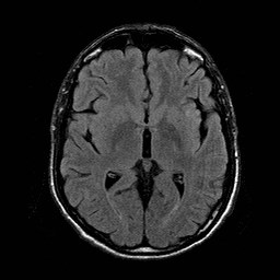 File:Central-variant posterior reversible encephalopathy syndrome (PRES) (Radiopaedia 43880-47359 Axial FLAIR 11).jpg