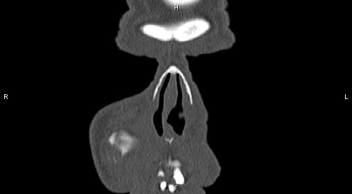 File:Central giant cell granuloma (Radiopaedia 83346-97761 Coronal bone window 2).jpg