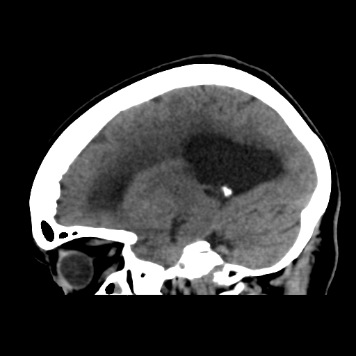File:Central neurocytoma (Radiopaedia 65317-74346 C 36).png