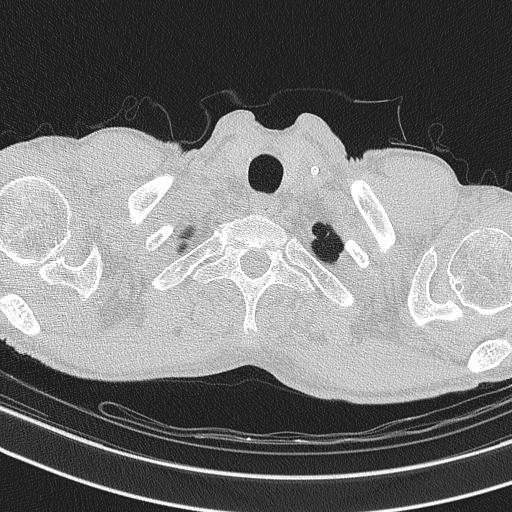 Central venous catheter tip extravasation (Radiopaedia 82828-97113 Axial lung window 9).jpg