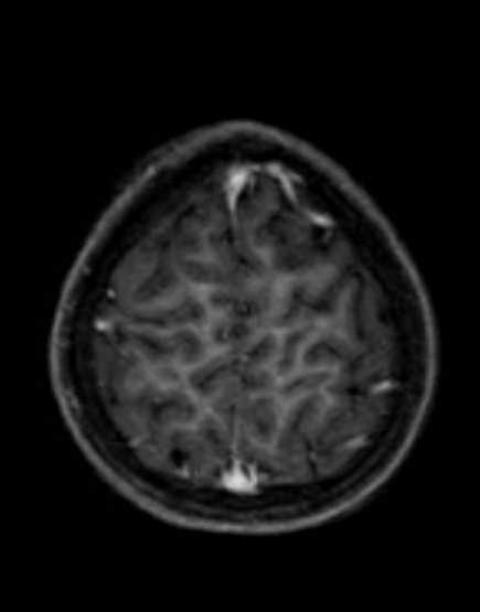 Cerebellar abscess (Radiopaedia 73727-84563 Axial T1 C+ fat sat 93).jpg