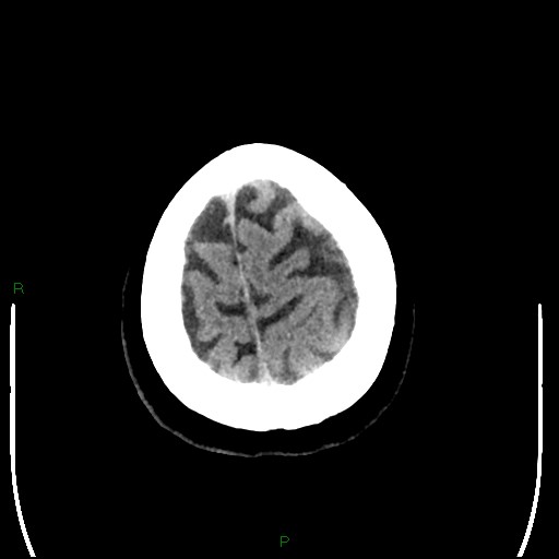 Cerebellar abscess (Radiopaedia 78135-90671 Axial non-contrast 101).jpg
