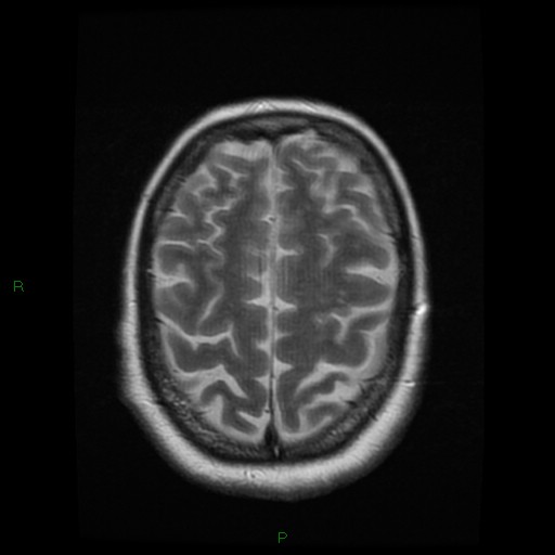File:Cerebellar abscess (Radiopaedia 78135-90678 Axial T2 24).jpg