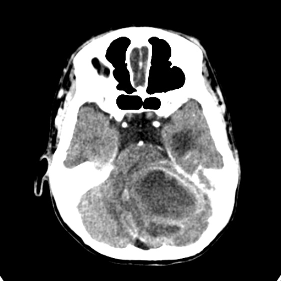 Cerebellar abscess secondary to mastoiditis (Radiopaedia 26284-26412 Axial C+ delayed 45).jpg
