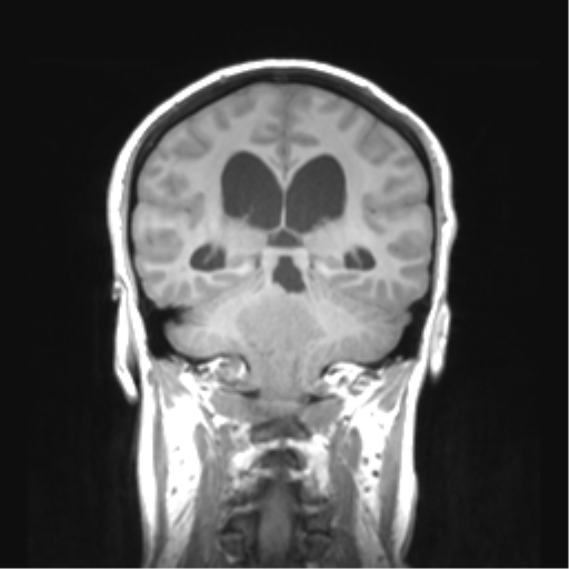 Cerebellar ependymoma complicated by post-operative subdural hematoma (Radiopaedia 83322-97736 Coronal T1 35).png