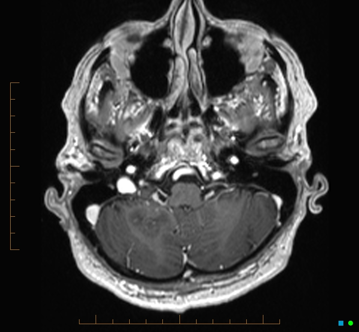 Cerebellar gangliocytoma (Radiopaedia 65377-74422 Axial T1 C+ 16).jpg