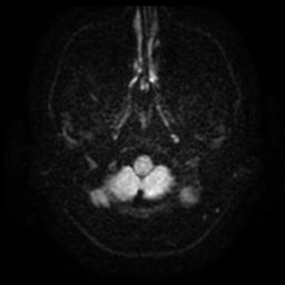 Cerebellar hemangioblastoma (Radiopaedia 29570-30077 Axial DWI 4).jpg