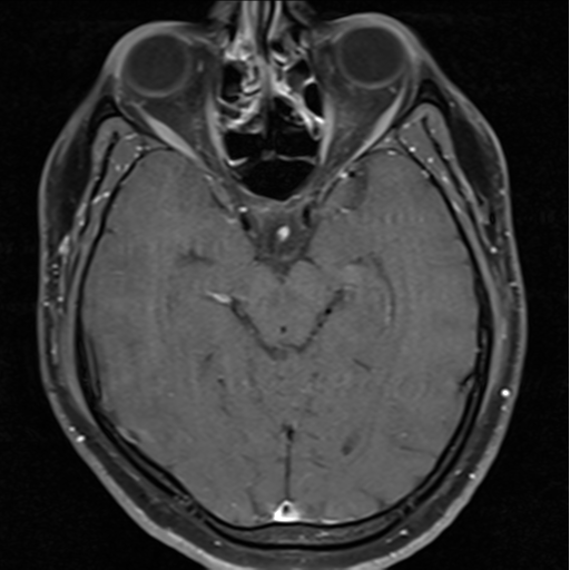 File:Cerebellar hemangioblastomas and pituitary adenoma (Radiopaedia 85490-101176 Axial T1 C+ fat sat 17).png