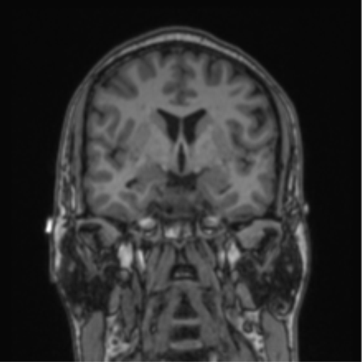File:Cerebellar hemangioblastomas and pituitary adenoma (Radiopaedia 85490-101176 Coronal T1 53).png
