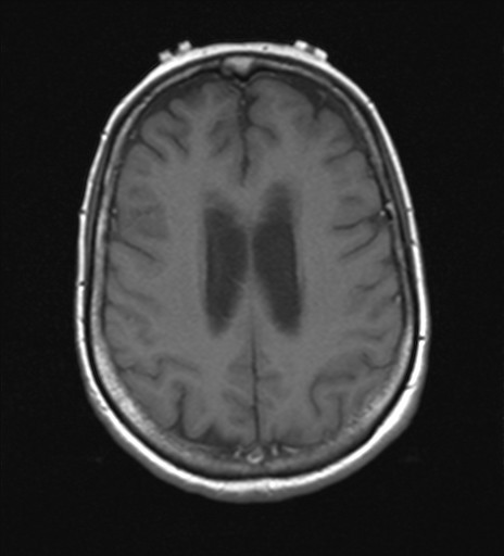 File:Cerebellar metastases (Radiopaedia 24038-24249 Axial T1 3).jpg