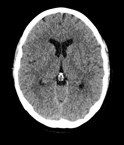 Cerebellar metastases - colorectal adenocarcinoma (Radiopaedia 40947-43652 Axial non-contrast 31).png