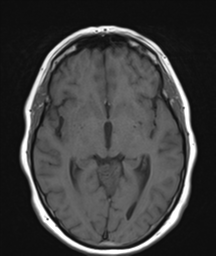 File:Cerebellar metastasis (Radiopaedia 54578-60810 Axial T1 18).png