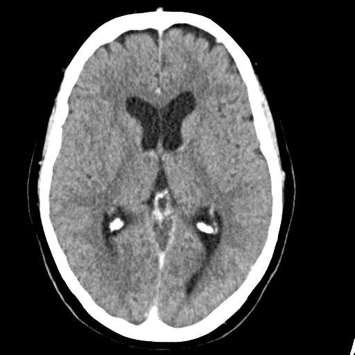 Cerebellar metastasis (Radiopaedia 54578-60812 Axial C+ 25).png