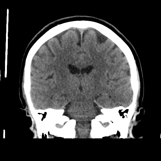 File:Cerebellar metastasis (cystic appearance) (Radiopaedia 41395-44258 Coronal non-contrast 36).png