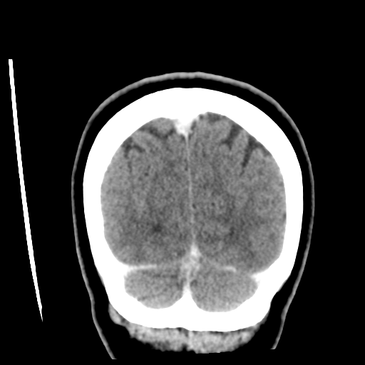 Cerebellar metastasis (cystic appearance) (Radiopaedia 41395-44258 D 52).png