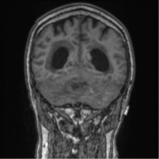 Cerebellar metastasis from lung adenocarcinoma (Radiopaedia 86690-102829 Coronal T1 32).png