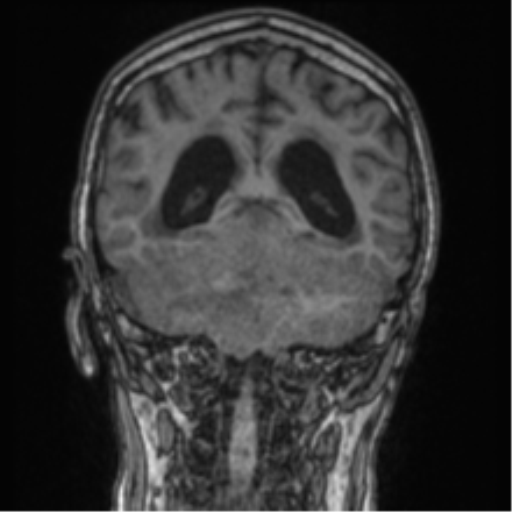 Cerebellar metastasis from lung adenocarcinoma (Radiopaedia 86690-102829 Coronal T1 38).png