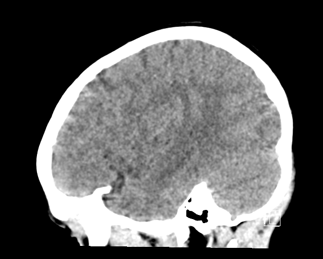 File:Cerebellar stroke (Radiopaedia 32202-33149 B 25).png