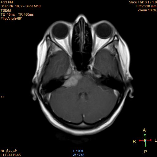 File:Cerebellopontine angle meningioma (Radiopaedia 22488-22525 Axial T1 C+ 4).jpg