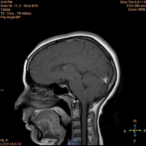 File:Cerebellopontine angle meningioma (Radiopaedia 22488-22525 Sagittal T1 C+ 8).jpg