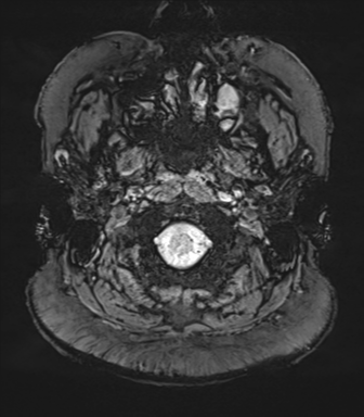 Cerebellopontine angle meningioma (Radiopaedia 48434-53348 Axial SWI 4).png