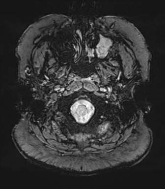 Cerebellopontine angle meningioma (Radiopaedia 48434-53348 Axial SWI 6).png