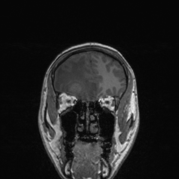 Cerebral abscess (Radiopaedia 24212-24478 Coronal T1 59).jpg
