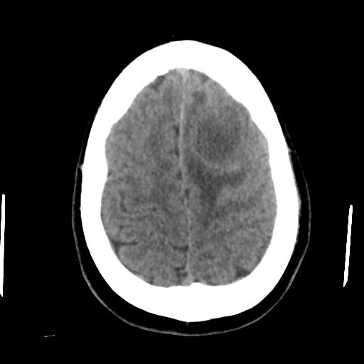 Cerebral abscess (Radiopaedia 29451-29919 Axial non-contrast 41).jpg