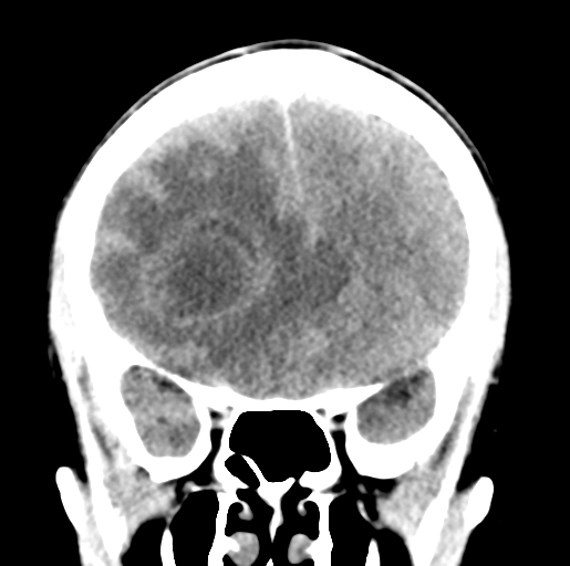 Cerebral abscess (Radiopaedia 60342-68008 Coronal non-contrast 21).png