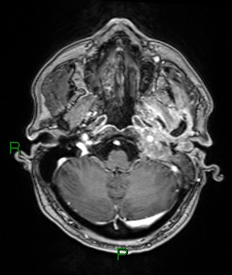 Cerebral abscess and subdural empyema (Radiopaedia 84436-99779 Axial T1 C+ 70).jpg