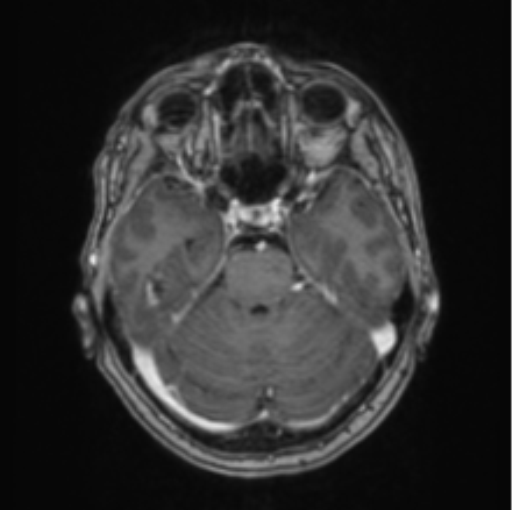 Cerebral abscess from pulmonary arteriovenous malformation (Radiopaedia 86275-102291 Axial T1 C+ 27).png