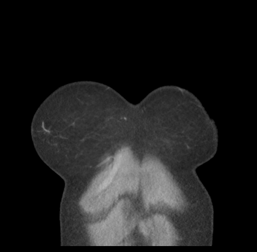 Cerebral abscess from pulmonary arteriovenous malformation (Radiopaedia 86275-102292 C 7).png