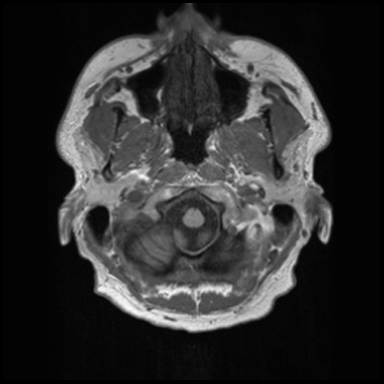 File:Cerebral abscess with ventriculitis (Radiopaedia 78965-91878 Axial T1 3).jpg