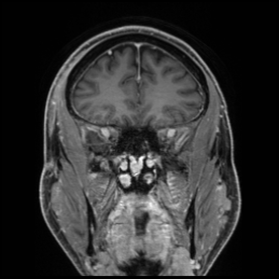 Cerebral abscess with ventriculitis (Radiopaedia 78965-91878 Coronal T1 C+ 20).jpg