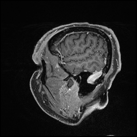 Cerebral abscess with ventriculitis (Radiopaedia 78965-91878 Sagittal T1 C+ 31).jpg