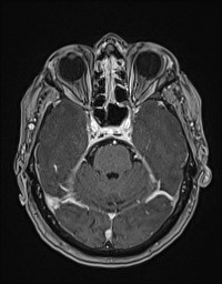 Cerebral amyloid angiopathy-related inflammation (Radiopaedia 58270-65377 Axial T1 C+ fat sat 41).jpg