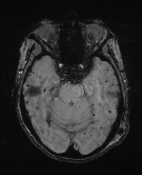 File:Cerebral amyloid angiopathy-related inflammation (Radiopaedia 74836-85849 Axial SWI 24).jpg