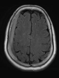 File:Cerebral amyloid angiopathy (Radiopaedia 29129-29518 Axial FLAIR 16).jpg